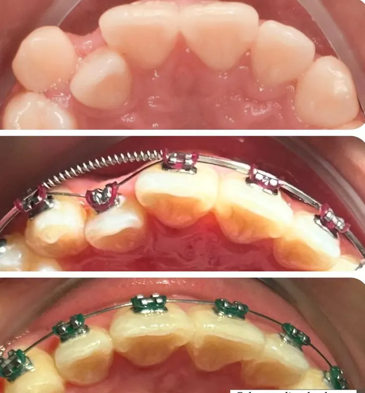 Paciente 1 Invisalign 1_2 1 (1)
