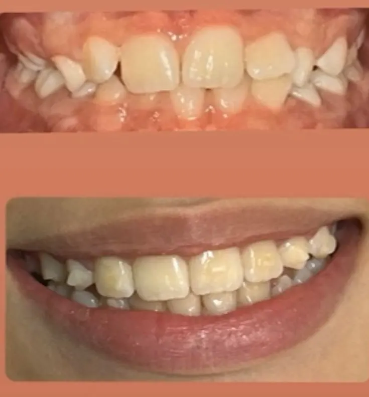 Paciente 1 Invisalign 1_2 1 (2)