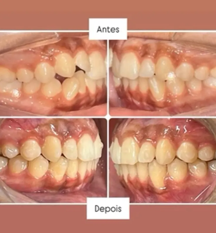 Paciente 1 Invisalign 1_2 2